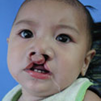 Kenneth vorher, Operation Restore Hope